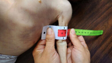 سنتيمترات معدودة.. أذرع أطفال غزة تختصر حجم مأساة الجوع