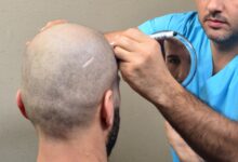 كيف أتوضأ بعد زراعة الشعر؟ عضو مركز الأزهر تجيب