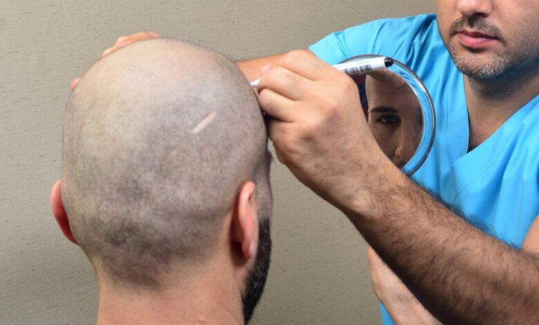 كيف أتوضأ بعد زراعة الشعر؟ عضو مركز الأزهر تجيب
