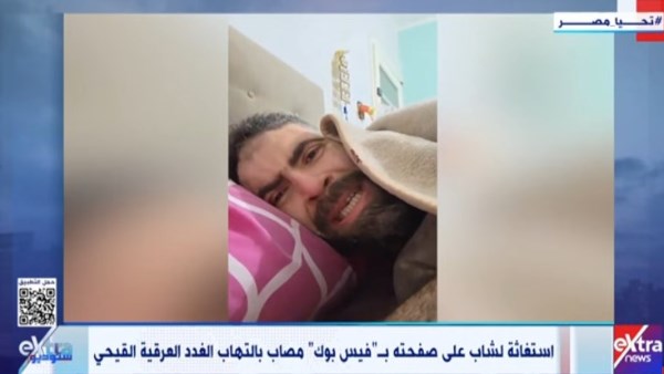 مصاب بالتهاب الغدد العرقية.. الصحة تستجيب لشاب بعد استغاثته عبر فيس بوك
