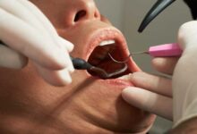 هل فينير الأسنان يؤثر على صحة الغُسل أو الوضوء؟.. دار الإفتاء تجيب